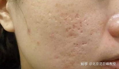 痘痘留下疤痕怎么办