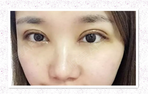 双眼皮为什么要开眼角