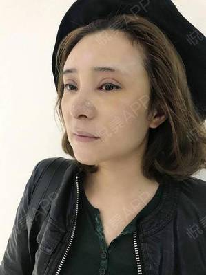 隆鼻可以侧身睡觉吗