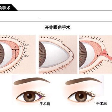 那些眼睛不适合开眼角