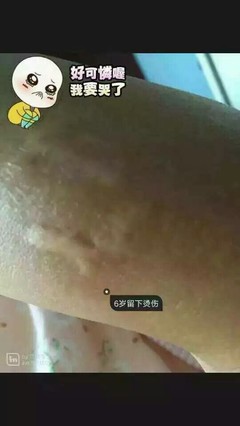 怀孕治脚气的土方法