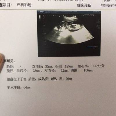 怀孕四个月怎么看男女