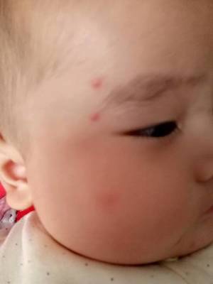 4个月宝宝脸上长红疙瘩