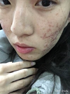 痘痘男護膚哪個好