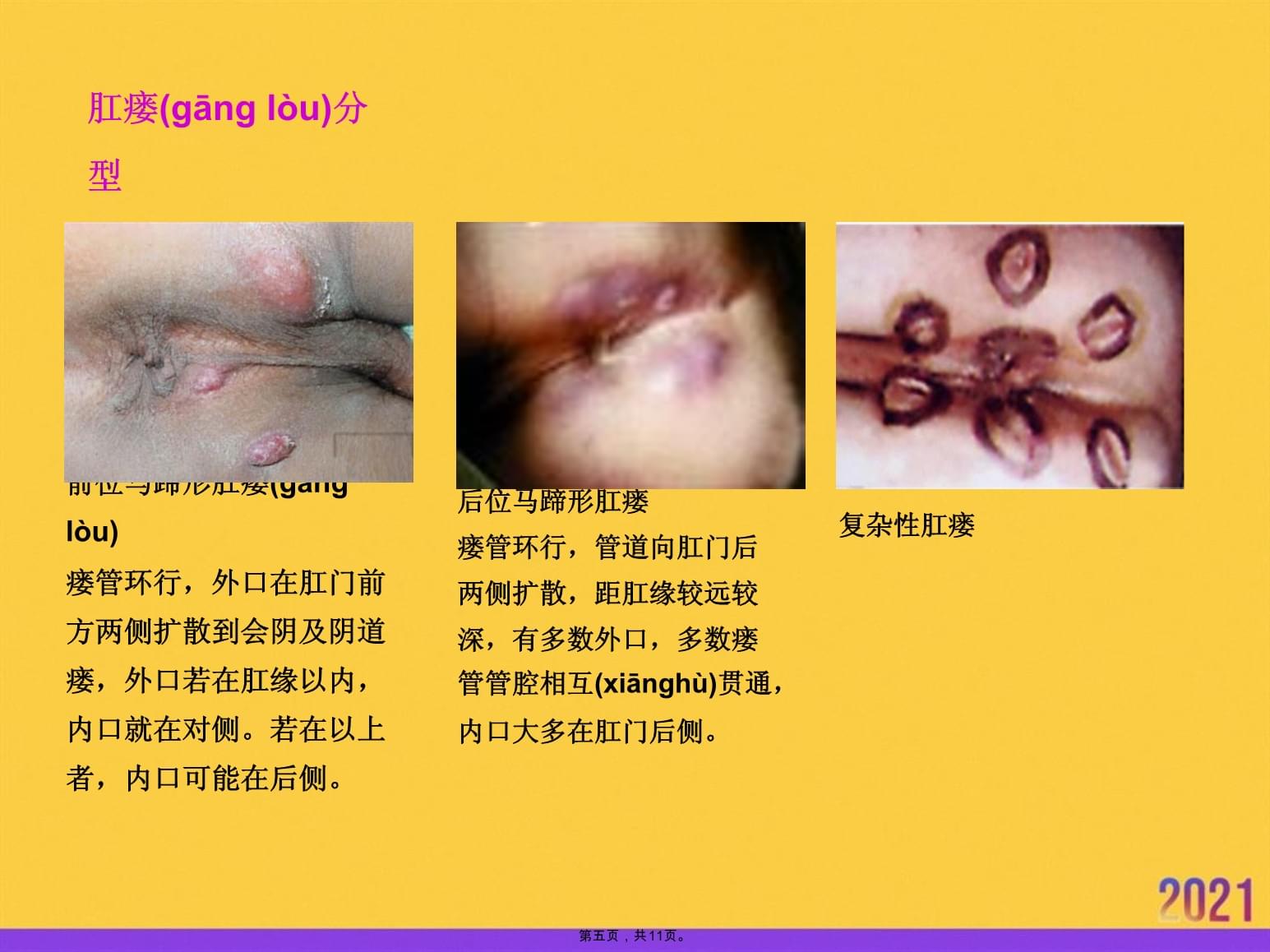 新生儿肛周脓肿图片