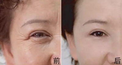 玻尿酸注射除皱效果