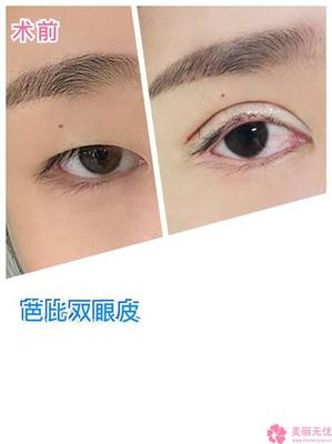 粘合双眼皮缺点