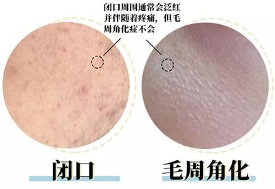 施尔美痘痘怎么消除