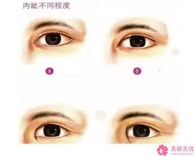 35岁割双眼皮