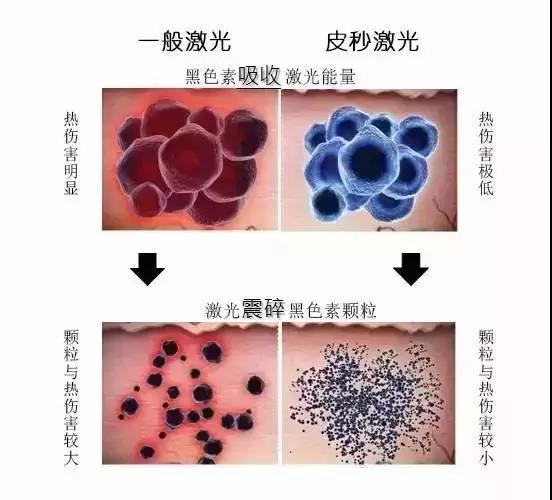 爆破祛斑对皮肤的伤害