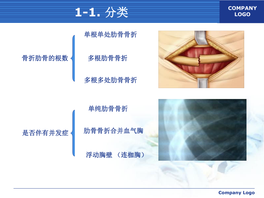 肋骨骨折需要怎么治疗