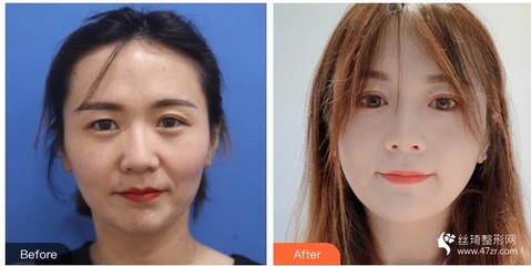 广西眼部整形