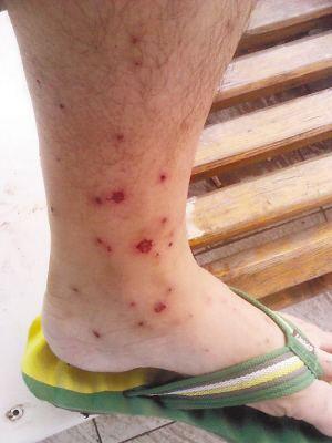 防治痘痘的10个必知点