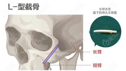 截骨多少钱