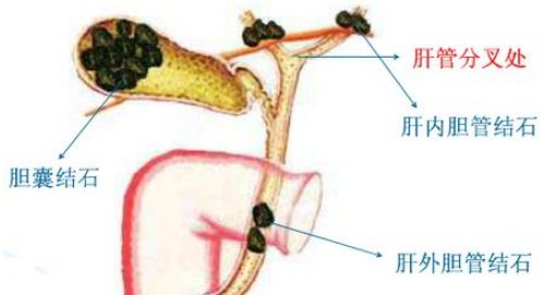 胆管结石怎么治疗