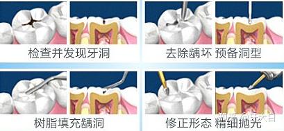 补牙后隐隐作痛