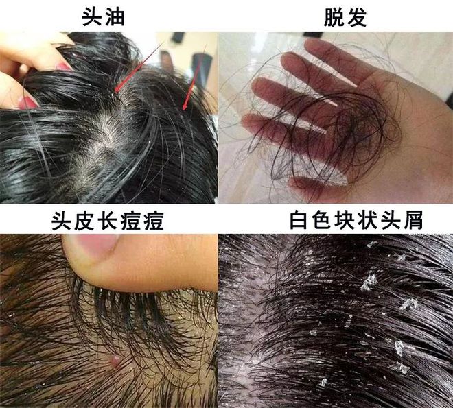 头皮长痘痘有点脱发