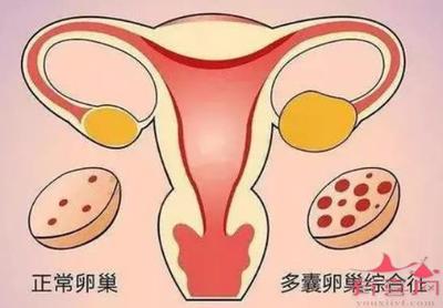 多囊会影响怀孕吗