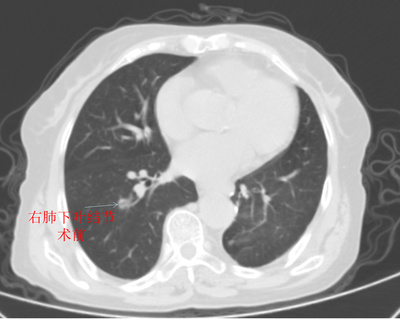 右肺下叶结节怎么治疗