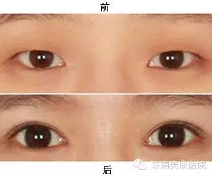 为什么双眼皮会变成三眼皮