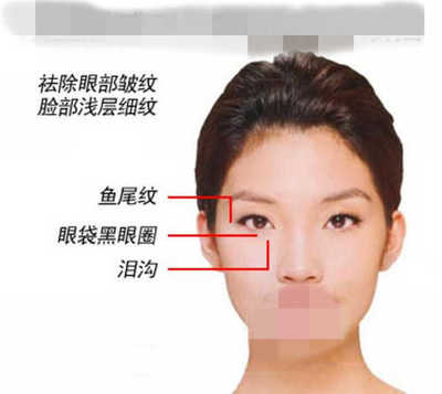 鱼尾纹除皱方法