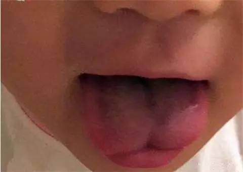 大舌头是怎么回事