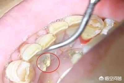 洗牙后牙龈萎缩