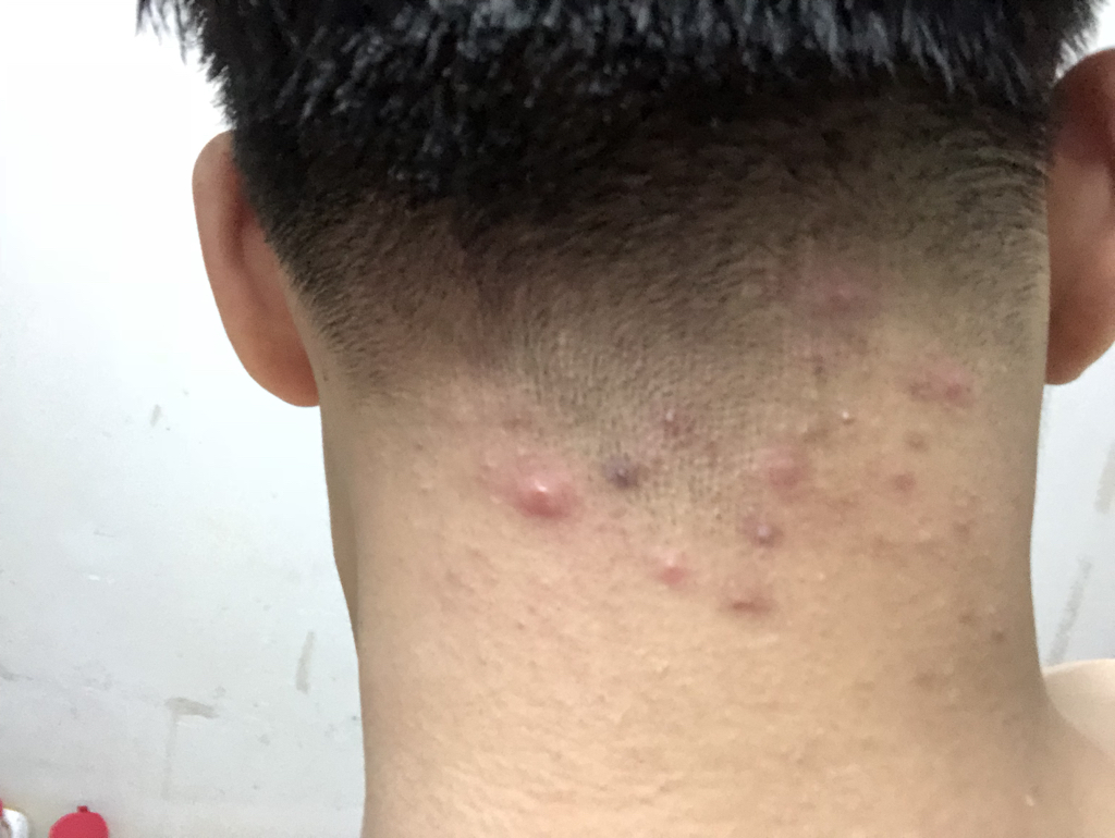 脖子长痘痘怎么治疗