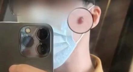 挤破痘痘能涂祛痘膏吗