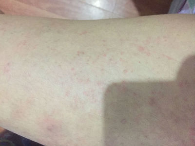 身上长疥疮怎么治疗