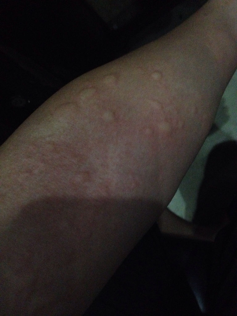 大腿长大痘痘怎么回事