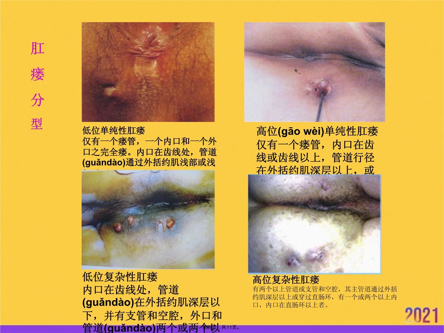 新生儿肛周脓肿图片