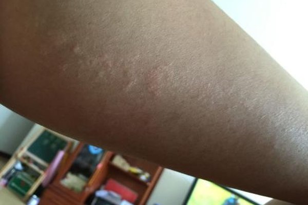 大腿长大痘痘怎么回事