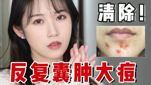 下巴总起囊肿型痘痘