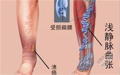 静脉曲张前期怎么治疗