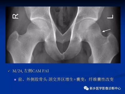 股骨头囊变是怎么回事