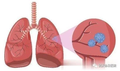 肺部结节怎么治疗