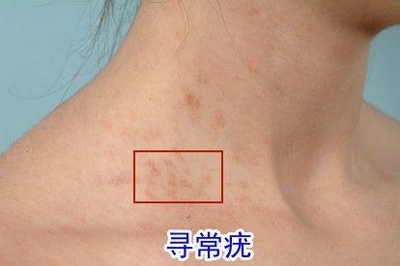 颈部怎么长了痘痘怎么回事