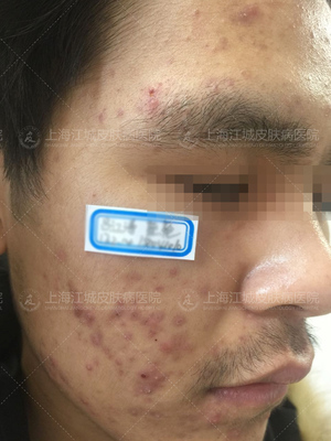 吴玉琴治疗痘痘怎么样