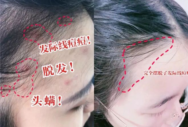 发际线有痘痘